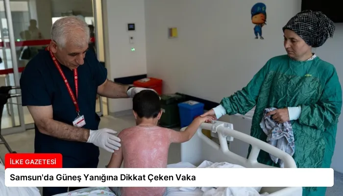 Samsun’da Güneş Yanığına Dikkat Çeken Vaka